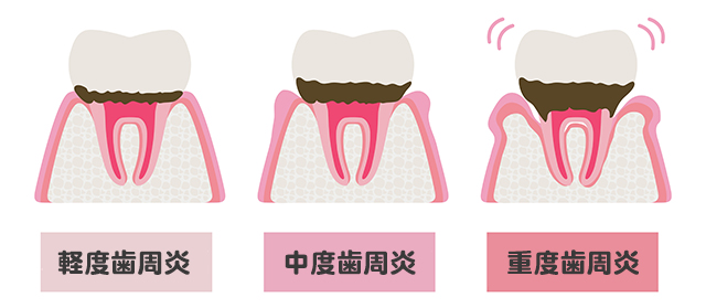 放置するとどうなる？進行度別チェック表